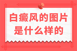 白癞病怎么治-有效治疗白斑的方法-好方法是什么