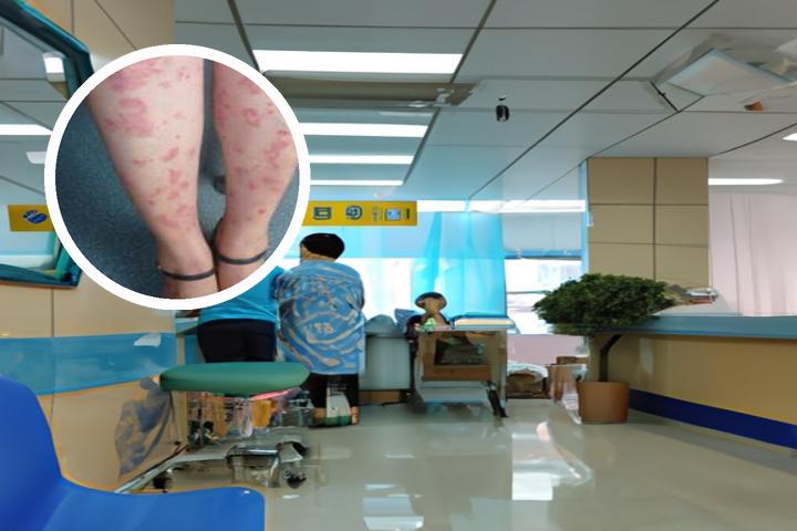 308光疗仪照射后皮肤痒